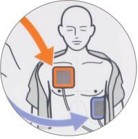 actiomedic-defibrillator-aed-3100-anwendung-02_en